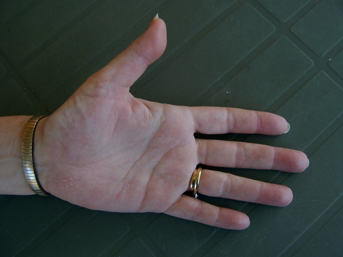 Hand affected by sponge envenomation